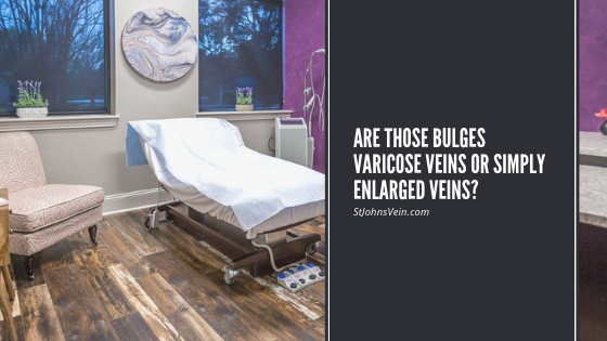 Are Those Bulges Varicose Veins or Simply Enlarged Veins?