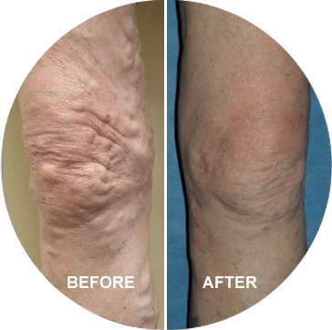 Vein Center Jacksonville, Vein Treatment, Varicose Veins, Spider Veins