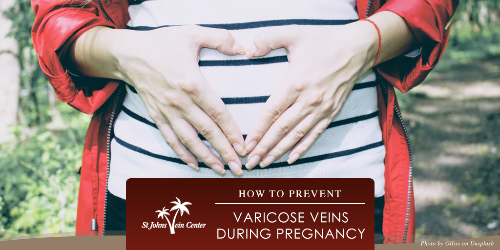 Prevent Varicose Veins During Pregnancy