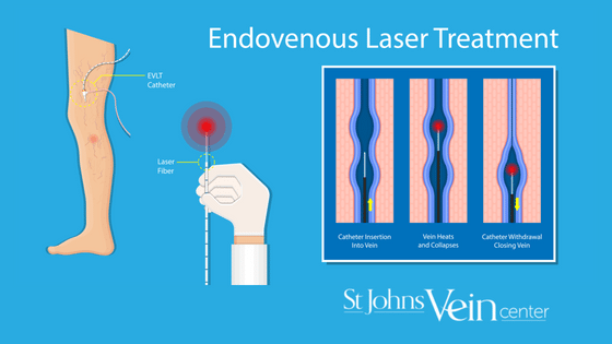 endovenous laser ablation