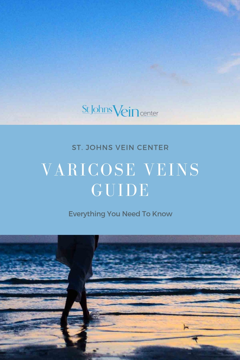 varicose veins guide