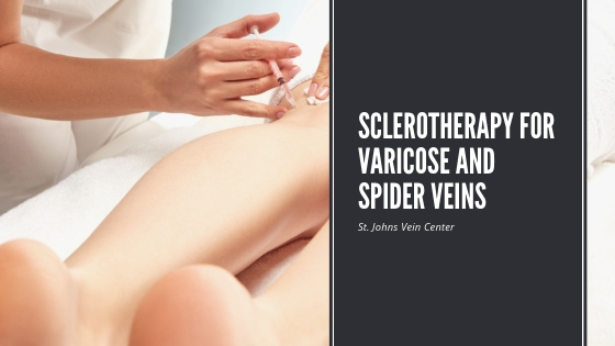 sclerotherapy for varicose and spider veins