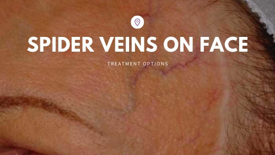 spider veins on face treatment