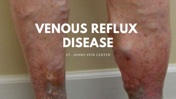 Venous Reflux disease