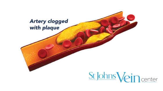How cholesterol affects your vascular health