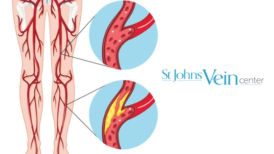 Peripheral Artery Disease Treatment In Jacksonville - St Johns Vein Center