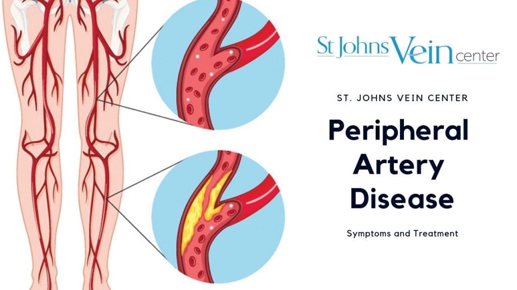 peripheral-artery-disease-diagnosis-and-treatment-options