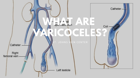 presentation of varicocele