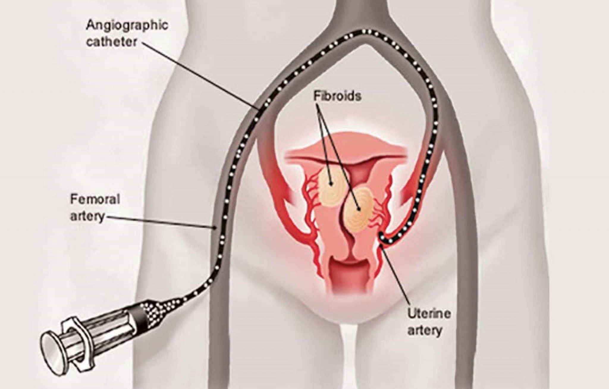 Uterine Fibroid Embolization St Johns Vein Center 