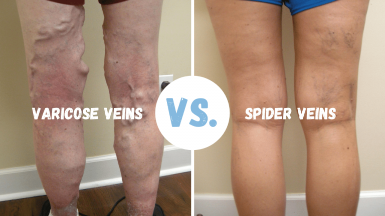 understanding-vein-disease-it-s-more-than-skin-deep