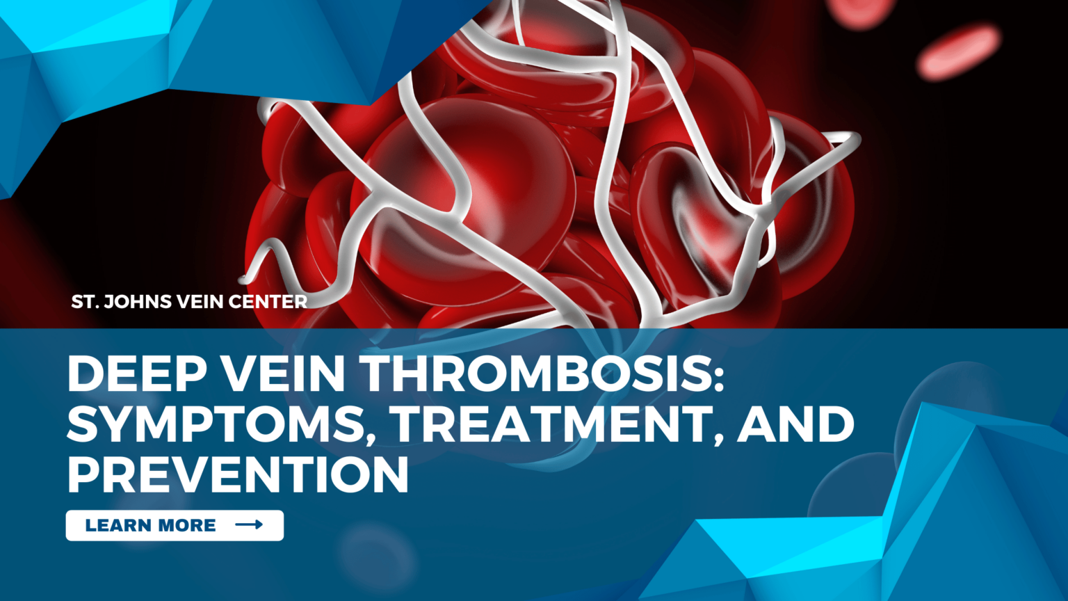 Deep Vein Thrombosis Symptoms Treatment And Prevention St Johns Vein Center