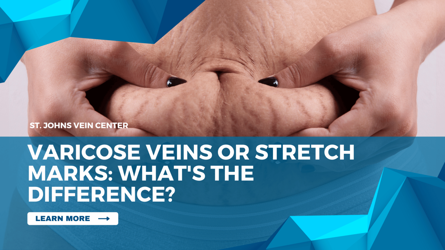 Varicose Veins Or Stretch Marks: What's The Difference? - St Johns Vein ...