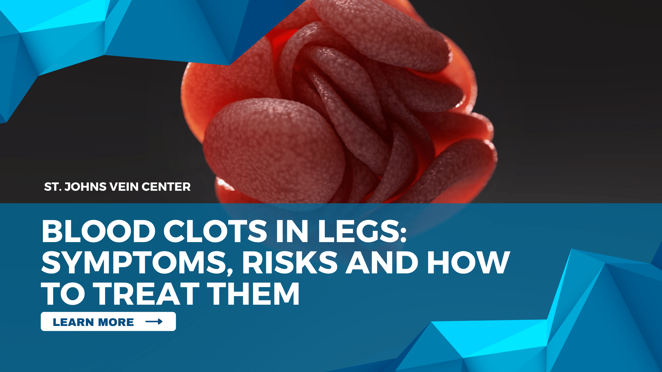 Blood Clots In Legs: Symptoms, Risks and How To Treat Them - St