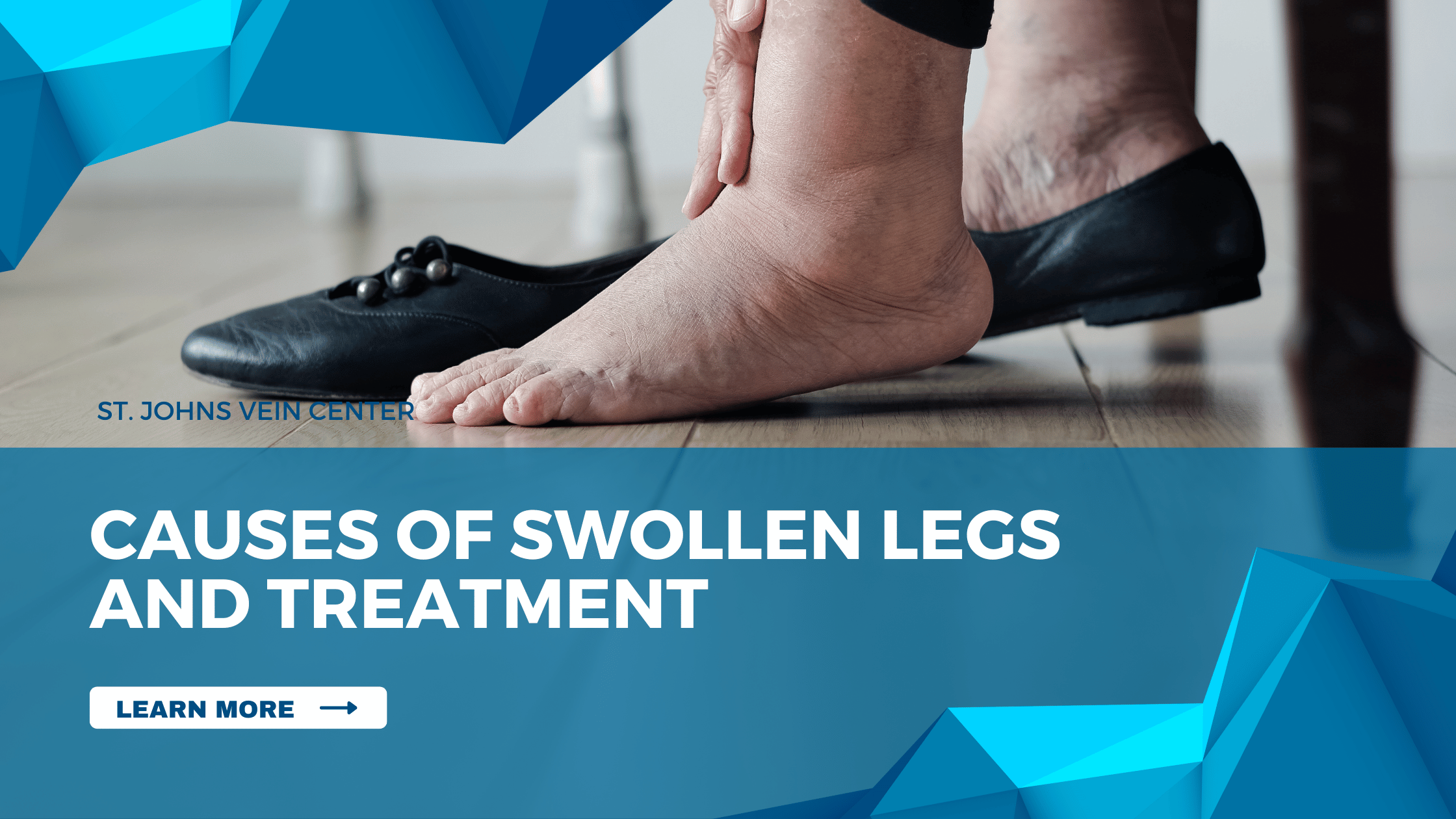 Causes of Swollen Legs and Treatment