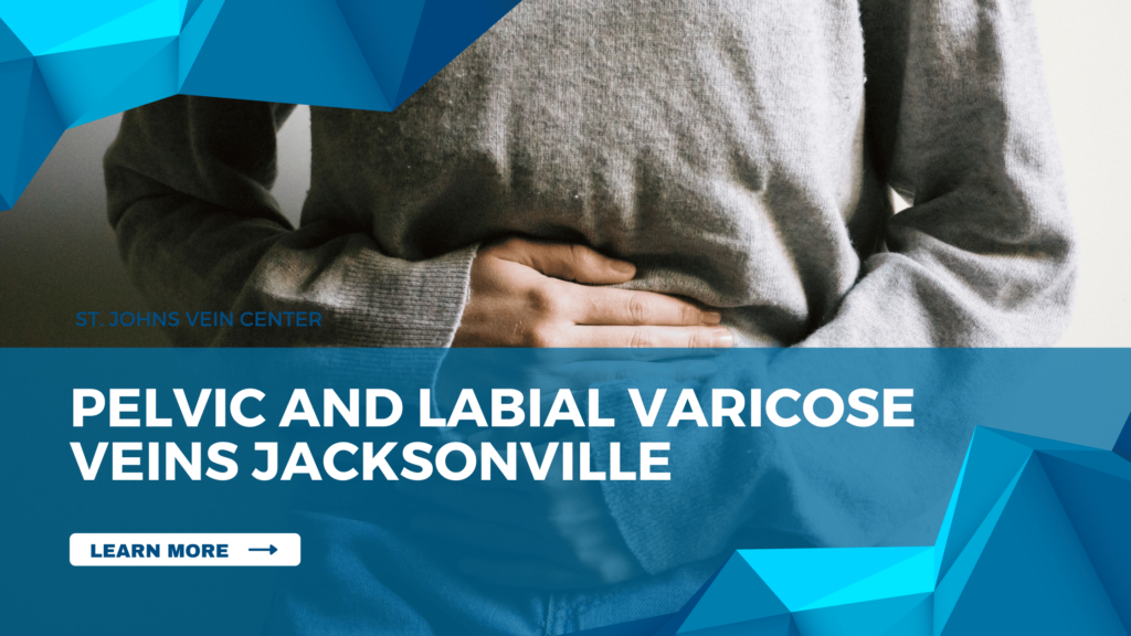 Pelvic and Labial Varicose Veins Jacksonville