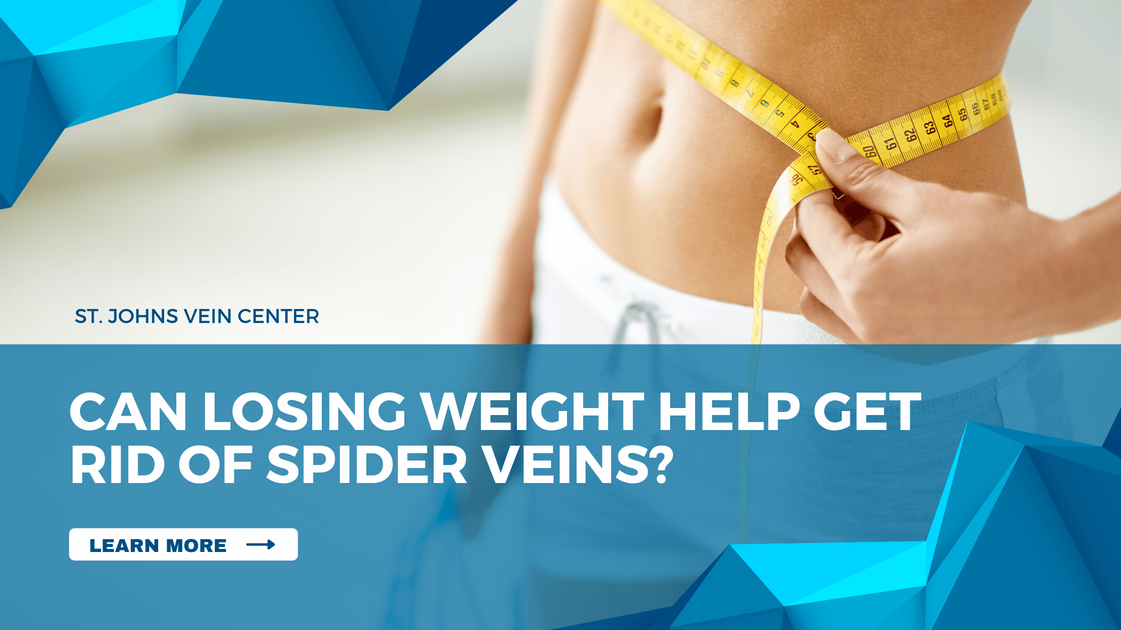 Can Losing Weight Help Get Rid of Spider Veins