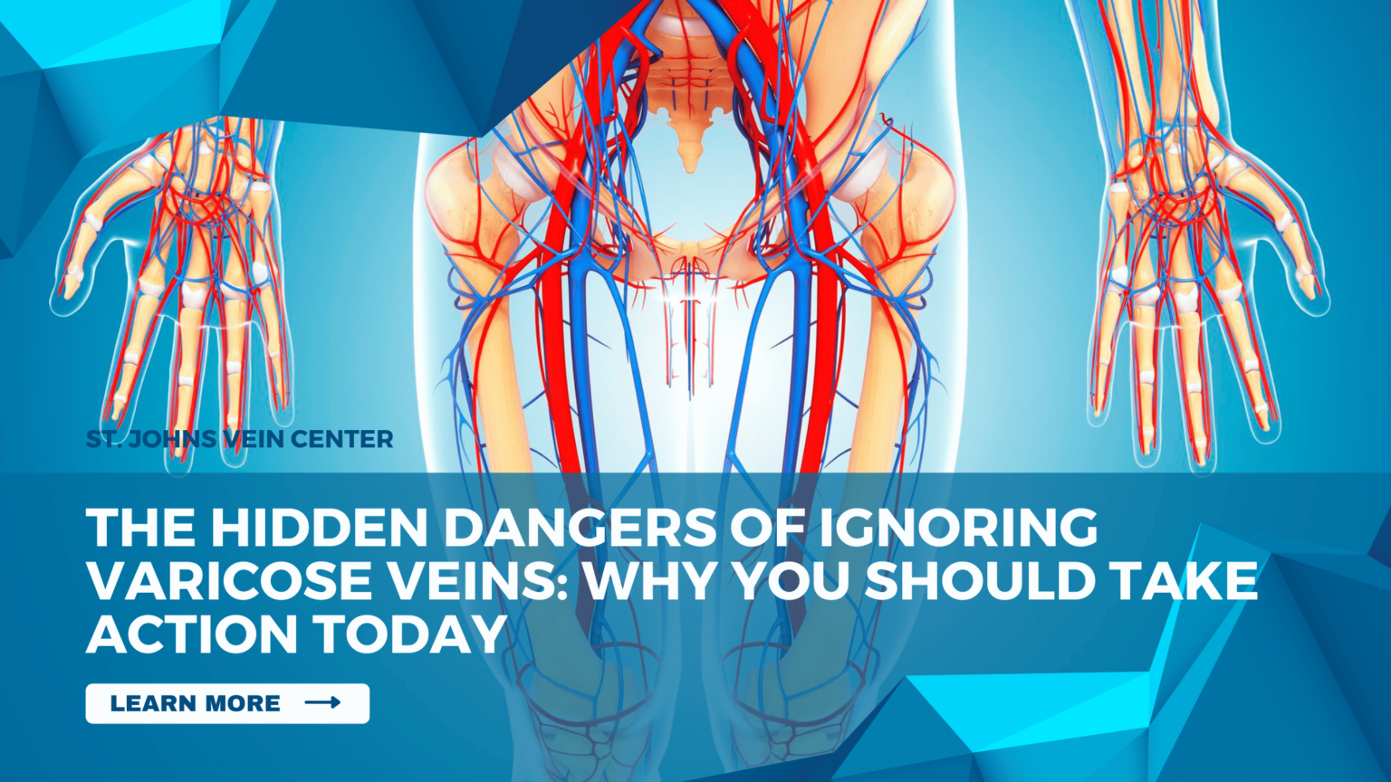 The Hidden Dangers Of Ignoring Varicose Veins Why You Should Take Action Today St Johns Vein 