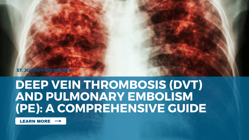 Deep Vein Thrombosis Dvt And Pulmonary Embolism Pe A Comprehensive Guide St Johns Vein Center