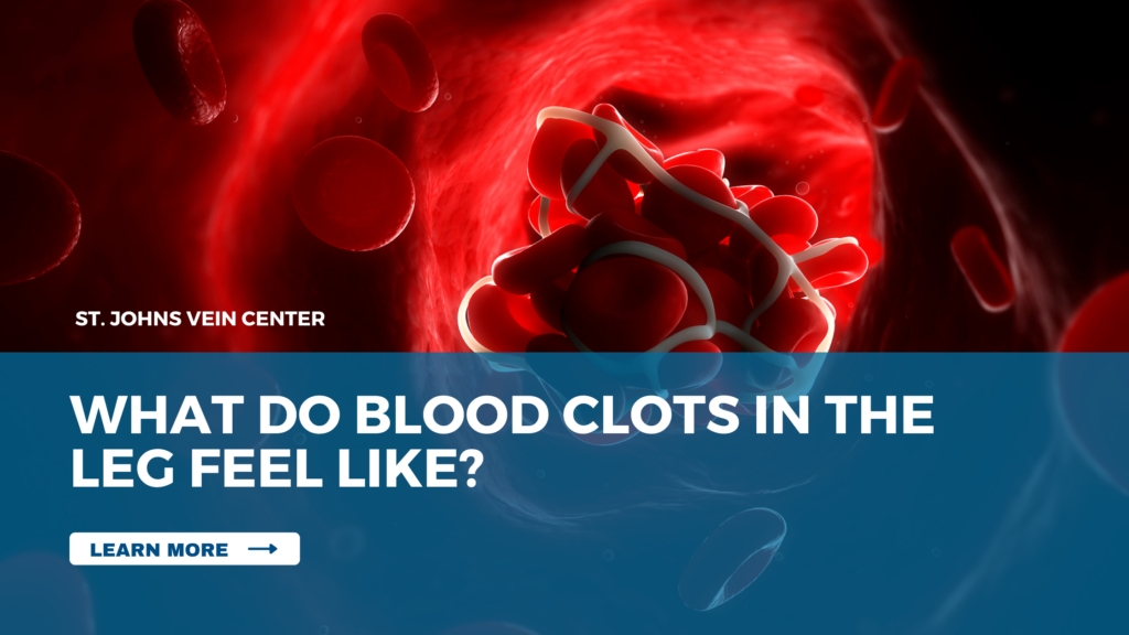 What Do Blood Clots in the Leg Feel Like? St Johns Vein Center