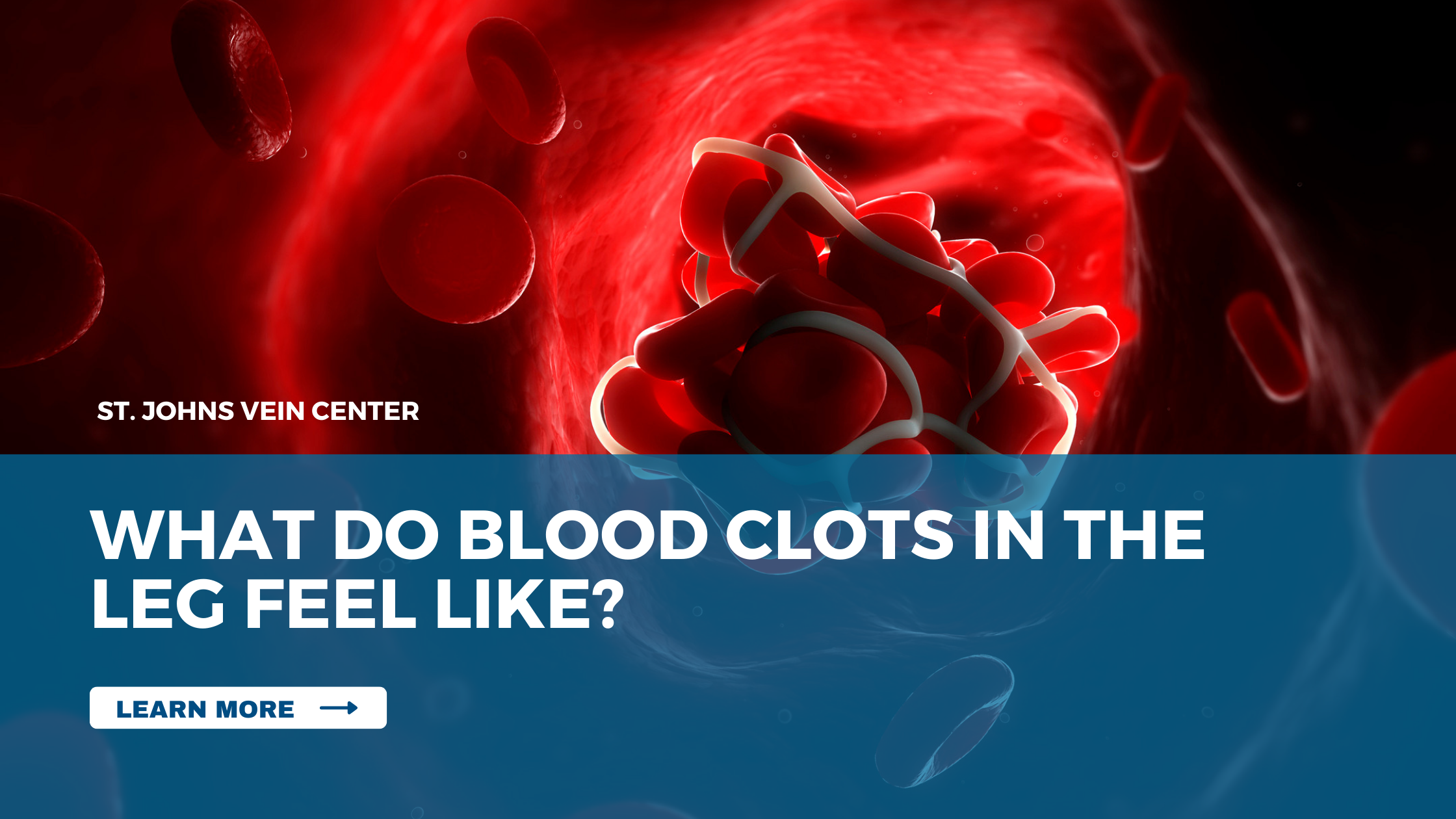 Blood Clots In Legs: Symptoms, Risks and How To Treat Them - St Johns Vein  Center