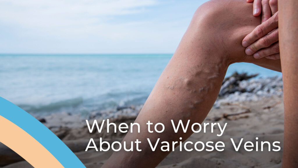 When to Worry About Varicose Veins?
