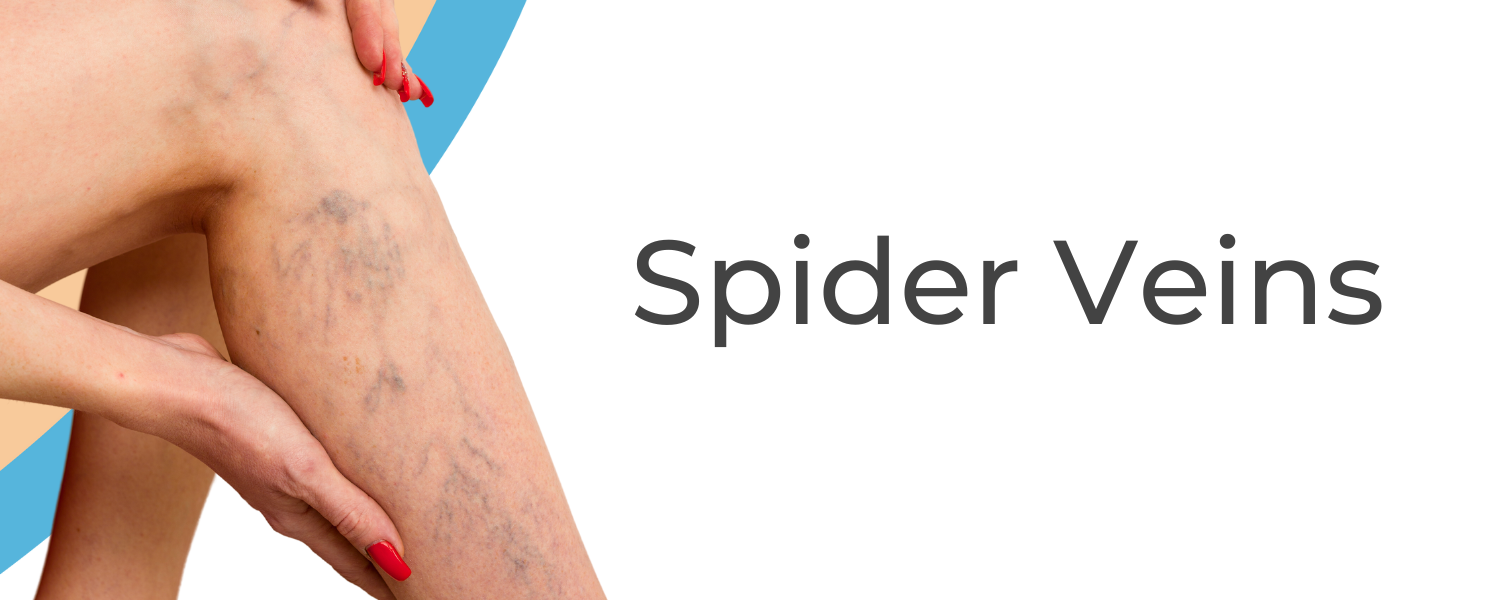 Causes of Spider Veins - Vein Solutions