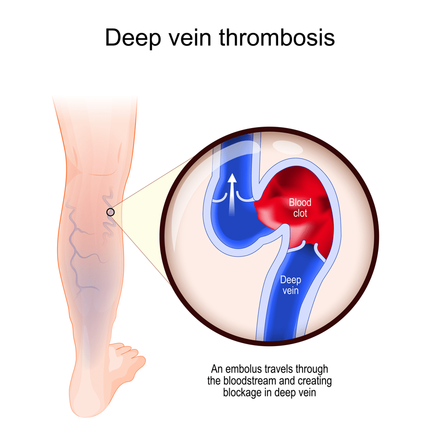Illustration of veins during deep vein thrombisis, Blood clot, Deep vein, An embolus travels through the bloodstream and creats blockage in deep vein