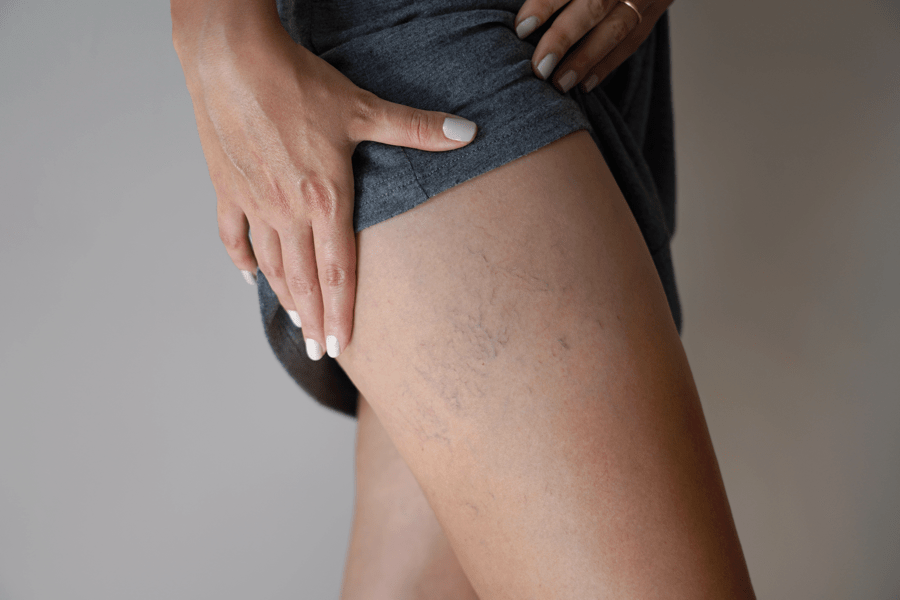 Woman exposing deep vein thrombosis on leg